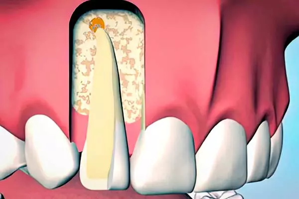 SAMPLE APICOECTOMY SURGICAL ROOT CANAL