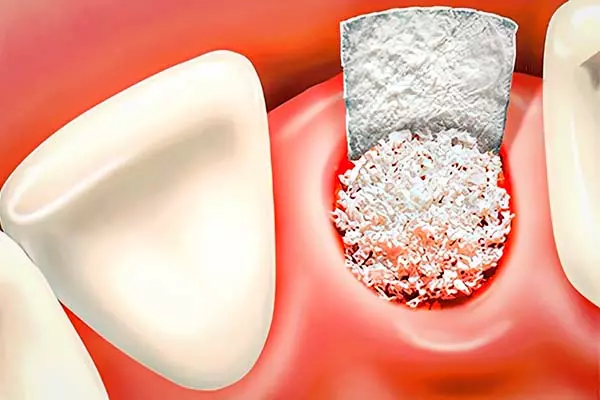 BONE GRAFTING/BONE REGENERATION AND RECONSTRUCTION