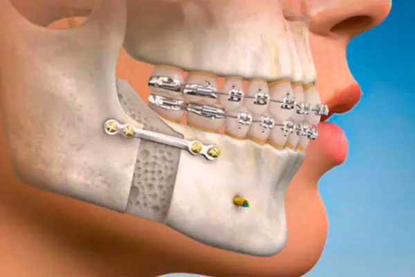 Treatment of facial trauma